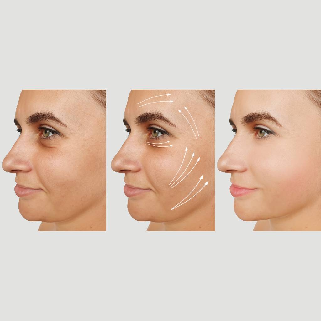 Aplicaciones Avanzadas de Botox
